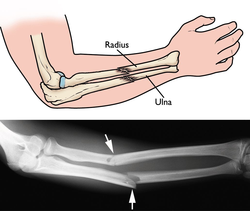 手臂骨折有哪些症状?