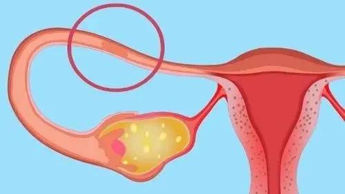 输卵管炎症是怎么引起的,5种方法控制输卵管炎