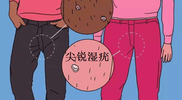 尖锐湿疣治疗期间注意事项有哪些?尖锐湿疣不能吃什么?_进行_患者_性