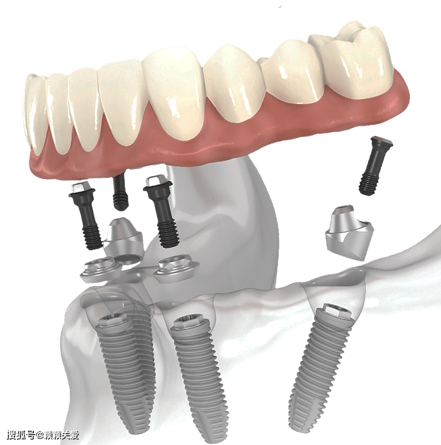 半口种植牙全过程