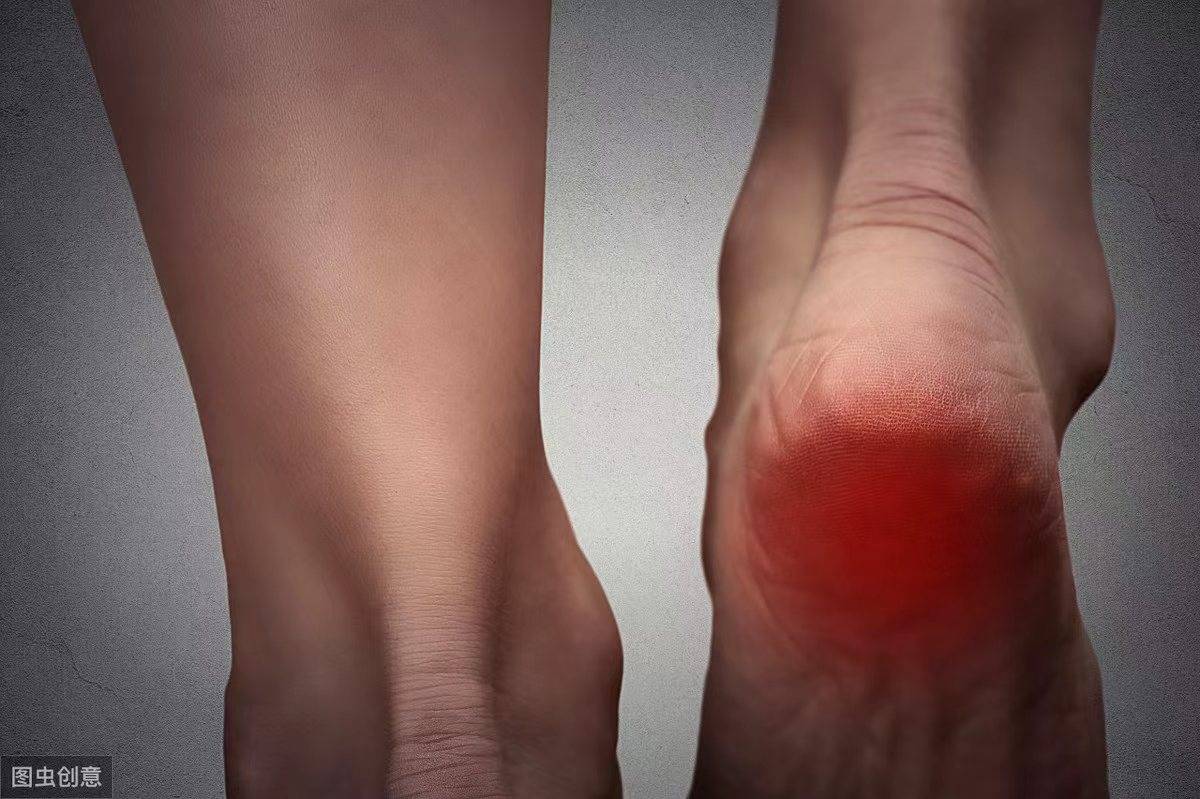 足底筋膜炎导致脚跟疼痛难忍?过来人教你如何缓解!