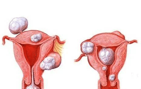 双唑泰阴道凝胶:妇科炎症的危害