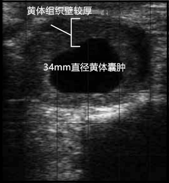 卵巢囊肿b超图图片