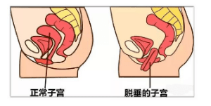 支持子宮正常位置的韌帶,筋膜,肌肉等會發生損傷和撕裂;宮口未開全便