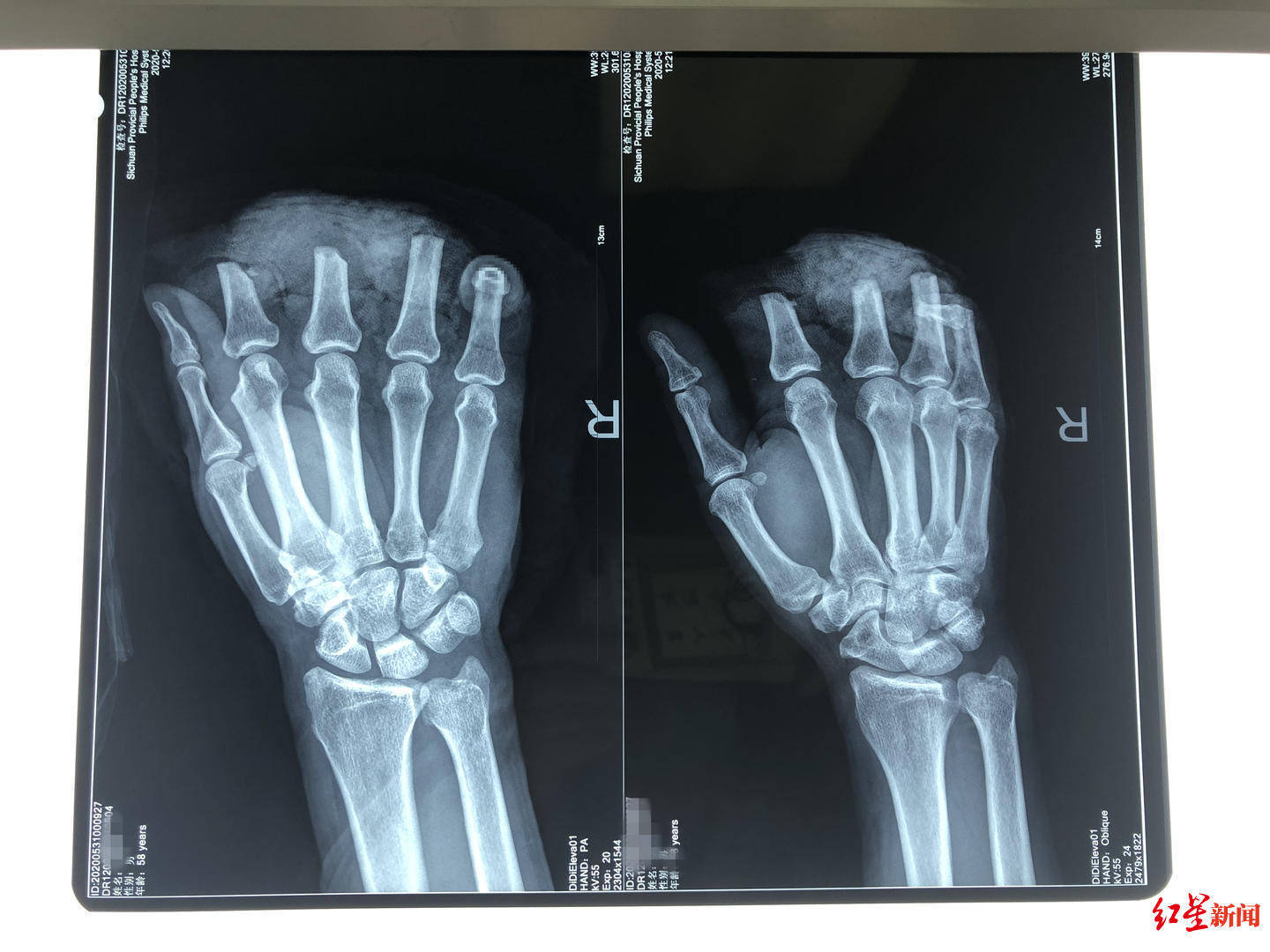 4指被切断医生用0 1毫米线缝合血管历时10小时完成断指再植 手指