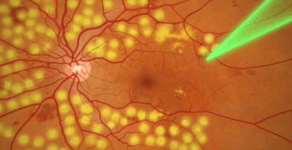 66爱眼日⑥神秘的眼底激光光凝术你知道多少