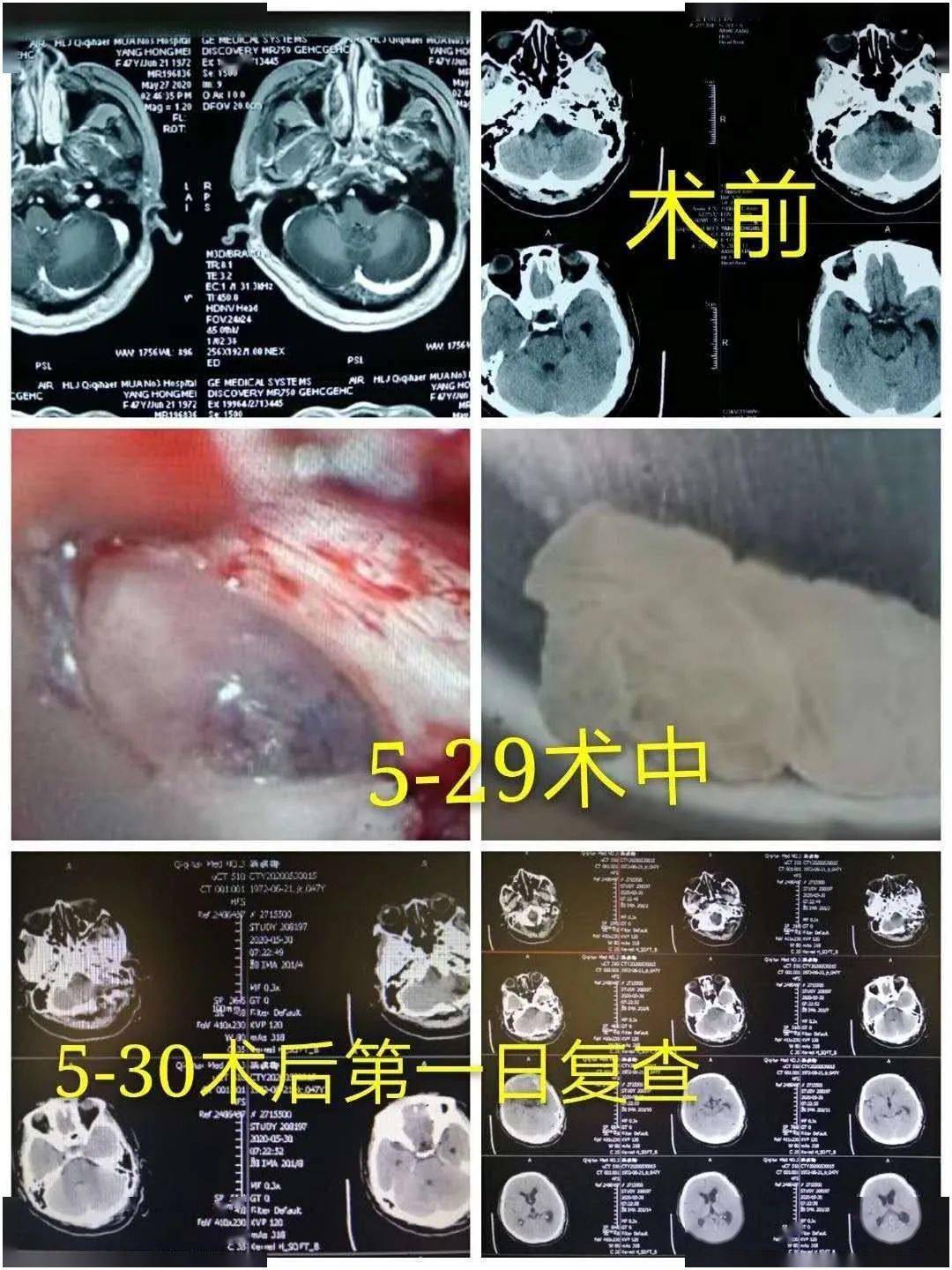 头痛三年多,竟是脑囊虫病!这种饮食习惯你可能也有_手机搜狐网