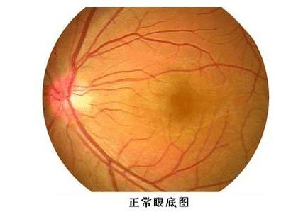 眼底疑云:挥之不去的"眼前一抹黑"
