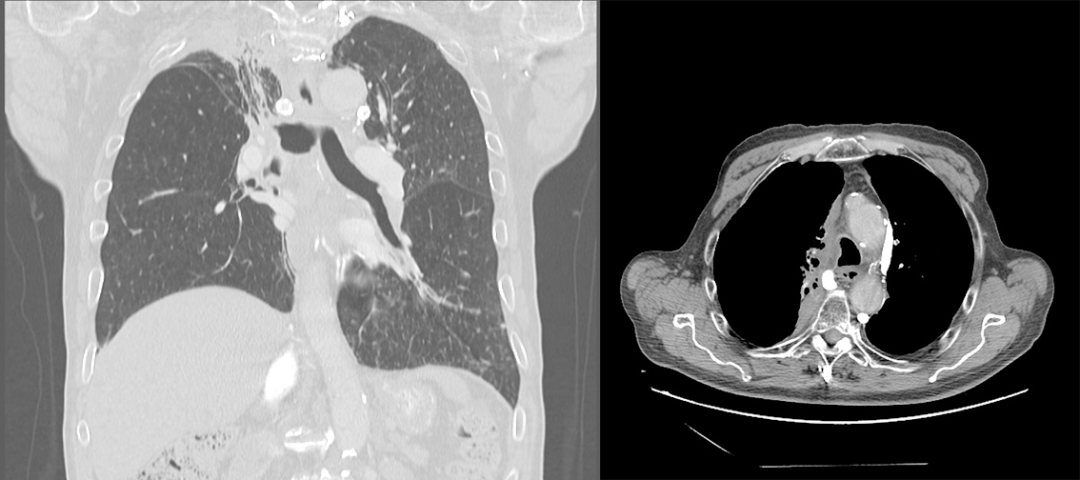 肺不张影像基本思路