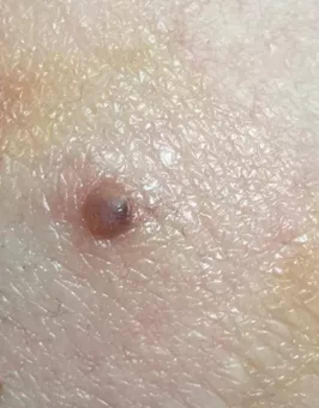 你有"痣"命危险吗?快来对照下