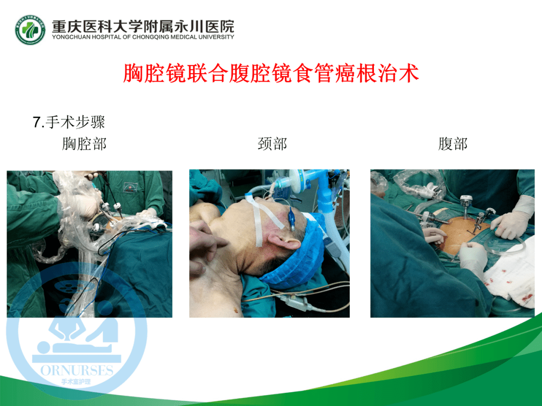 【ppt】胸腔镜联合腹腔镜食管癌根治术的手术配合