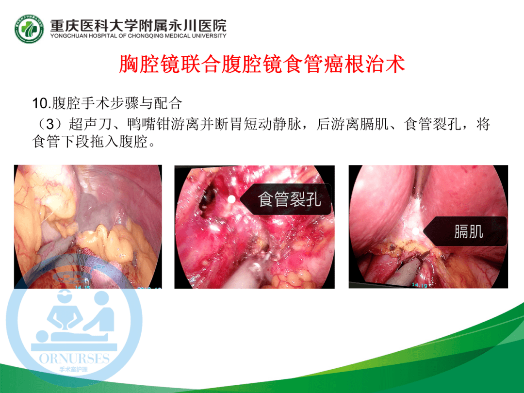 ppt胸腔鏡聯合腹腔鏡食管癌根治術的手術配合