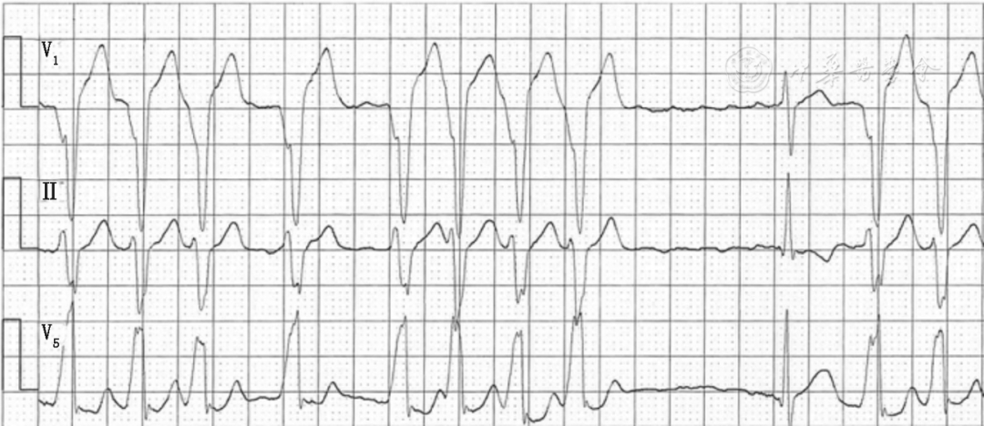 预激伴心房颤动的心电图表现