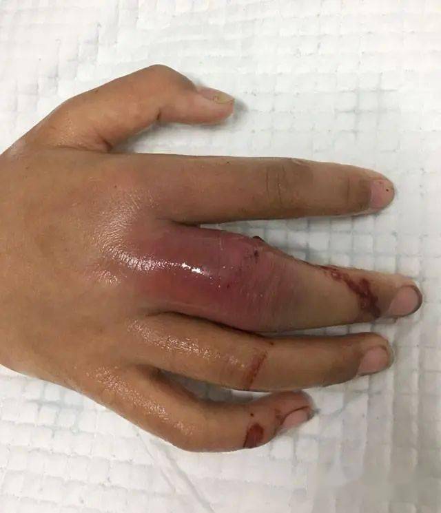 小龙虾的报复19岁小伙跟它握了下手结果