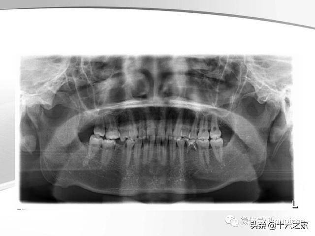 牙及牙周各種疾病影像學表現整理