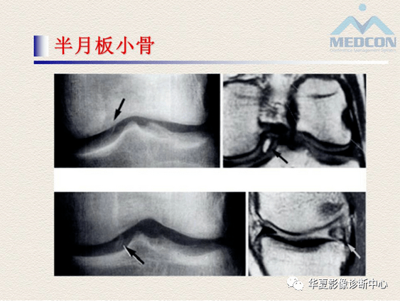 半月板的常见病变及正常变异的核磁共振诊断