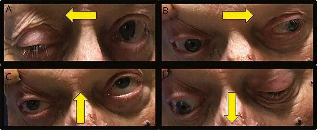 体格检查结果右侧动眼神经麻痹表现为明显的上睑下垂,右眼凝视正常(a)