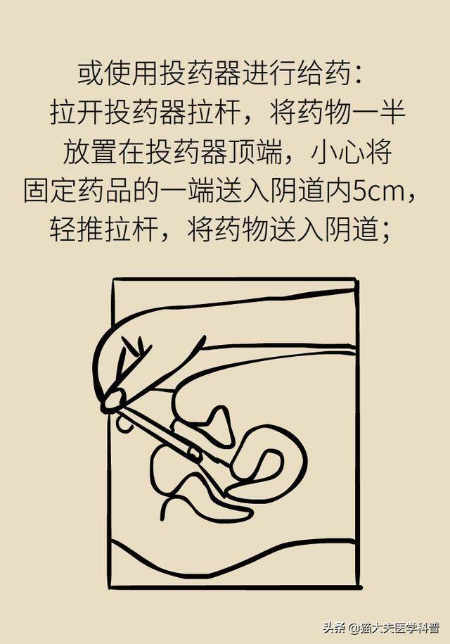 外阴阴道假丝酵母菌病