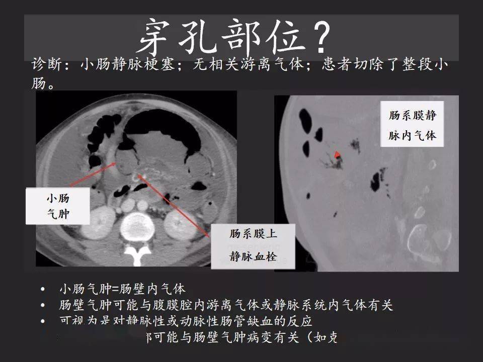 薛琪译站腹腔游离气体从哪里来如何应用腹膜解剖确定穿孔部位