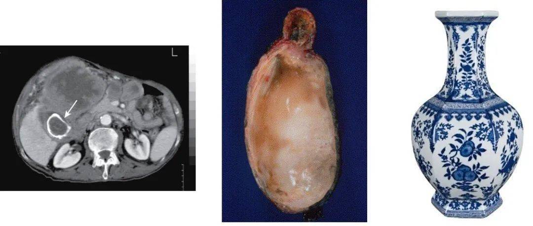 普外科的厨师们为大家准备了一套餐具——"瓷化胆囊".