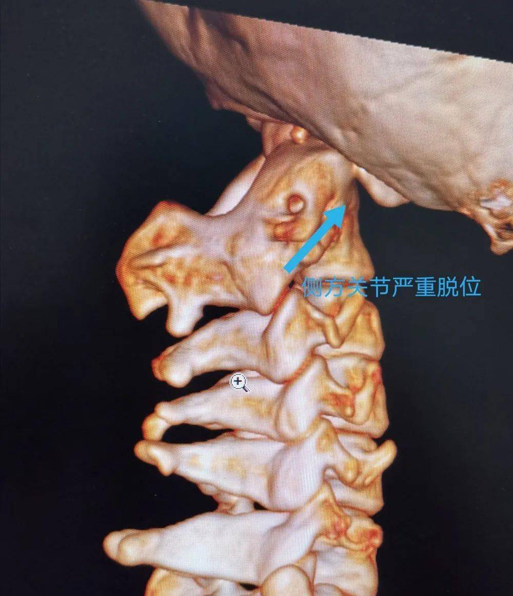 寰枢关节CT解剖图图片