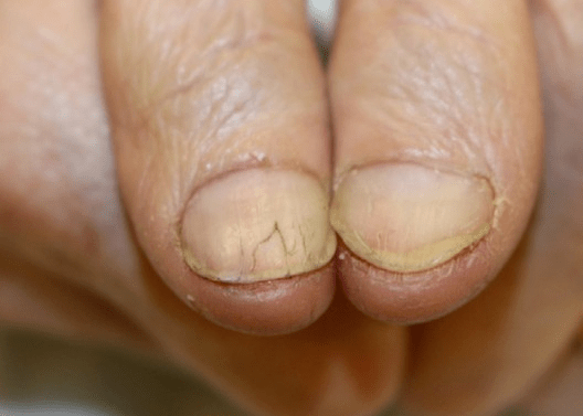心脏不好的人,指甲会有4表现,若没有,恭喜你心脏功能还不错