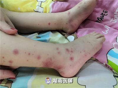 孩子关节肿痛腹痛别不当回事有这4种表现可能是过敏性紫癜