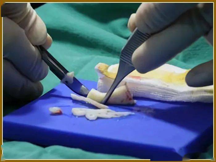 肋软骨隆鼻术后变形的原因分析及预防措施