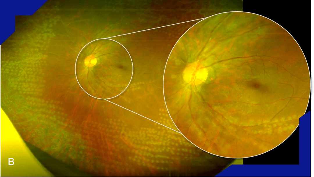 每周最佳病例分享视网膜血管炎