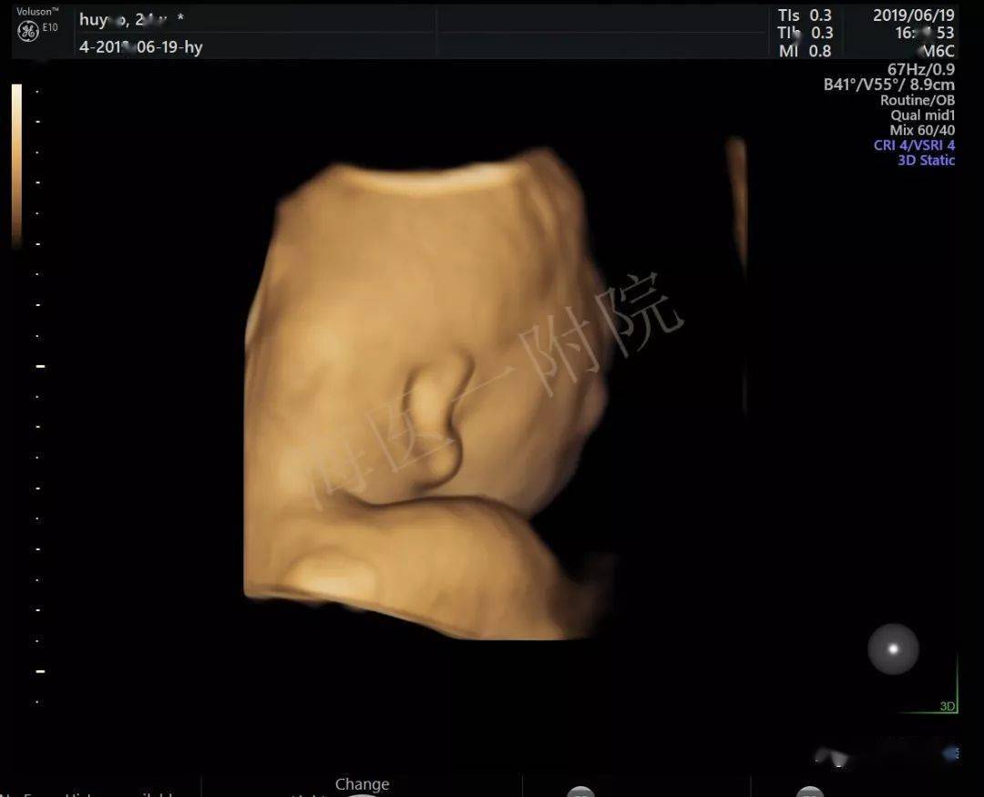胎儿小下颌畸形图片