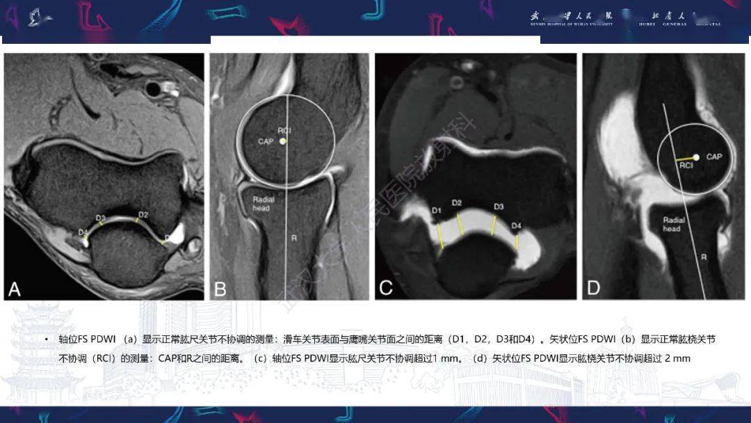 肘關節mri解剖及側副韌帶複合體常見損傷下