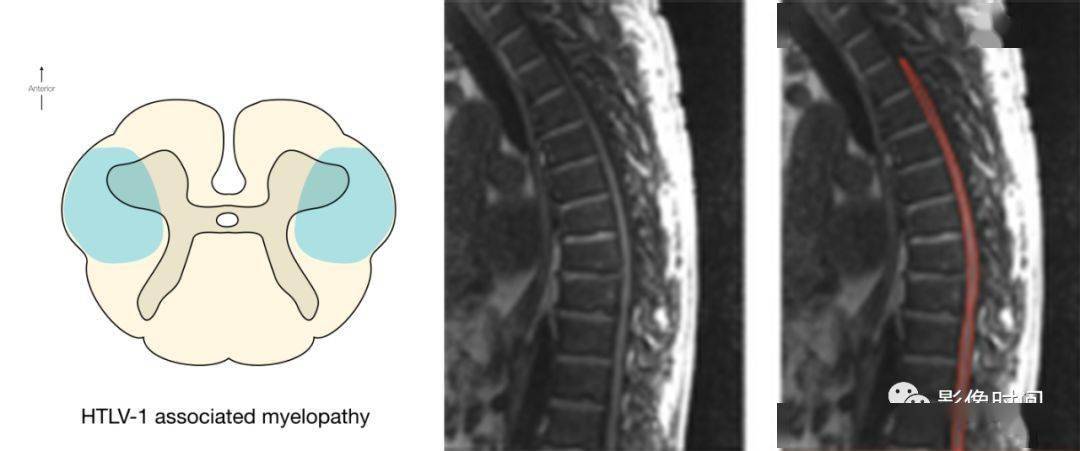 17 种脊髓病变影像解读,你 get 了吗