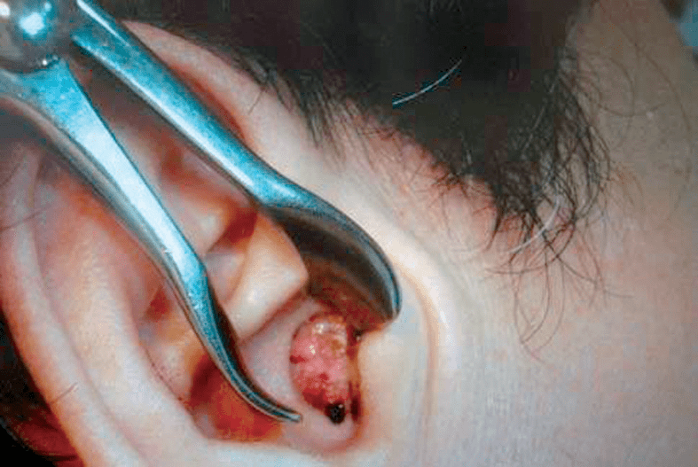 育儿智慧到底应不应该给娃掏耳朵华西专家耳屎真不是你想掏就能掏