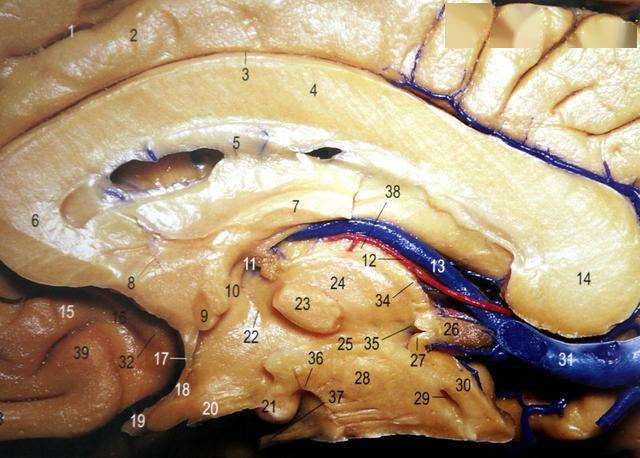 经胼胝体--透明隔间-穹隆间入路手术切除第三脑室肿瘤