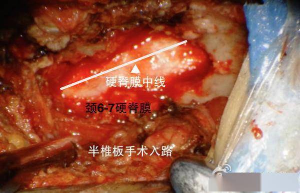 单侧半椎板入路椎管肿瘤切除手术