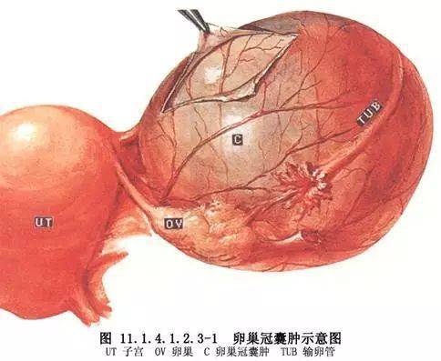 多囊卵巢综合征vs卵巢囊肿都对生育有影响吗该怎么治疗