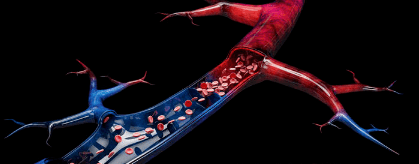 下肢静脉曲张究竟是什么?