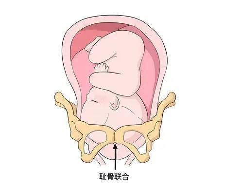 耻骨联合痛多发生在孕中晚期,随着孕周