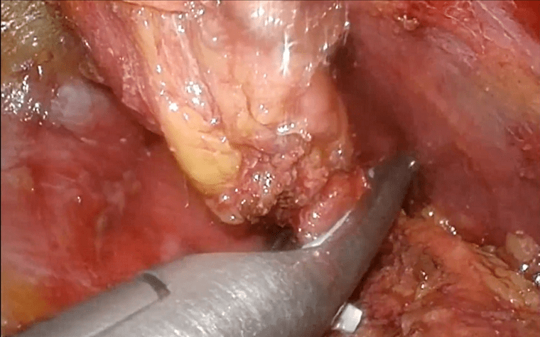 手术掠影观看高清手术视频手术演示微小腹腔镜肾上腺切除术适用于直径