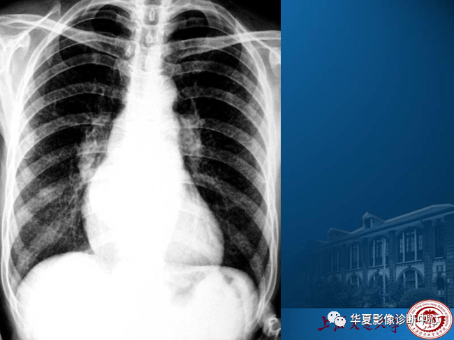 手把手教你阅读平片之胸部平片