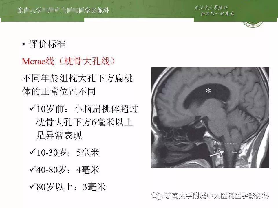 颞叶钩回疝ct图片图片