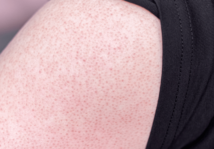 世上近一半的人都有天生的皮肤缺陷