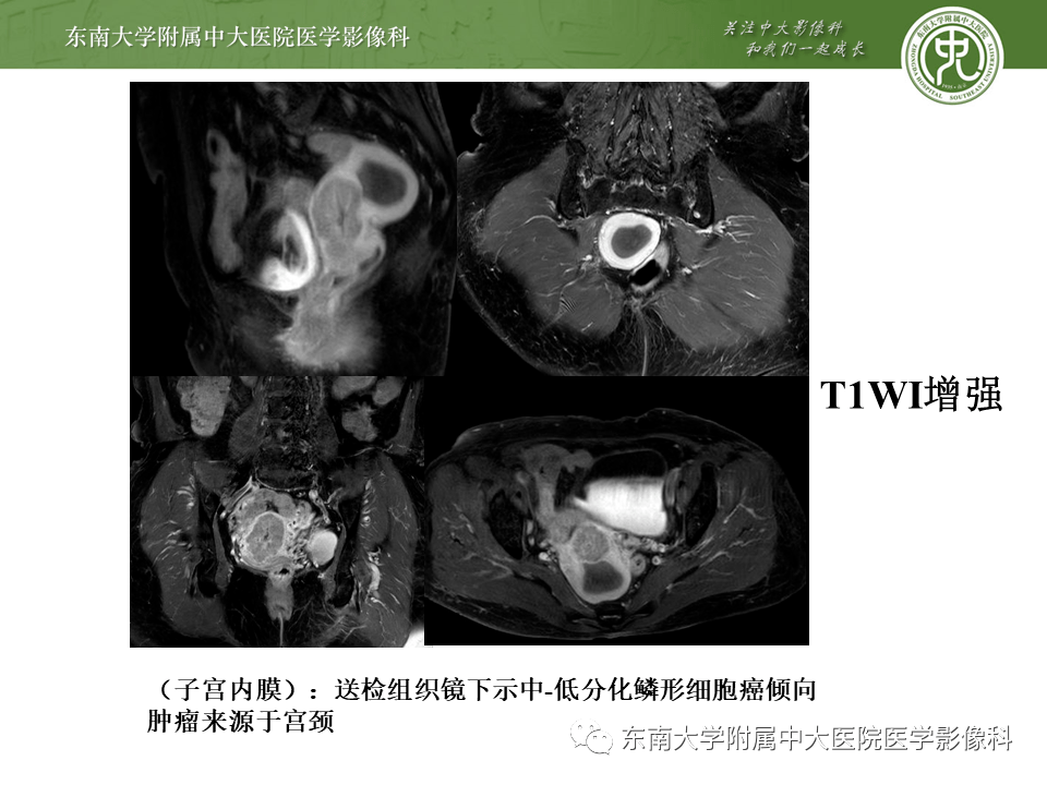 子宮內膜癌mri分期及結構式報告