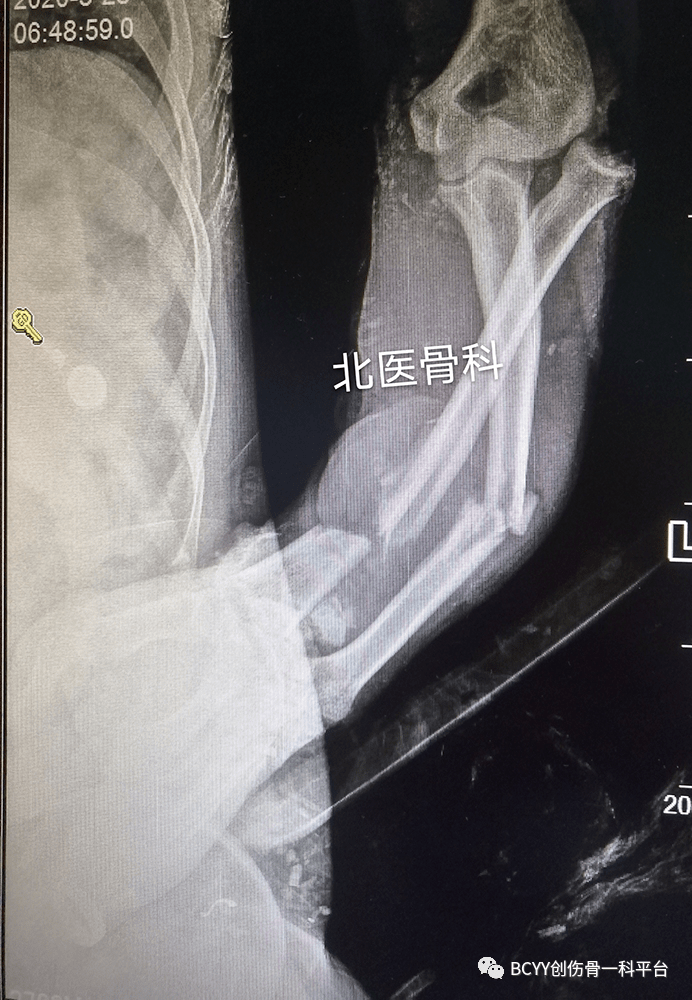 2,左肱骨干开放粉碎骨折伴骨缺损,左桡神经断裂,肱二头肌三头肌肱肌