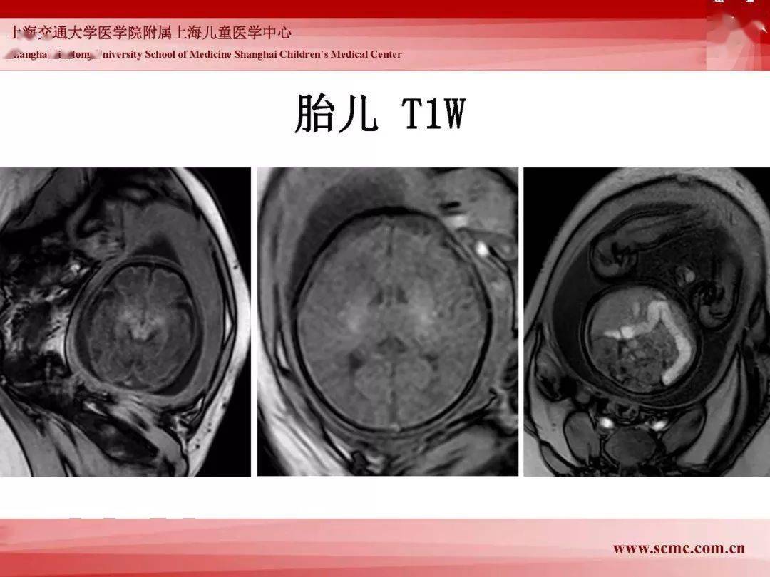 胎兒磁共振的檢查技術