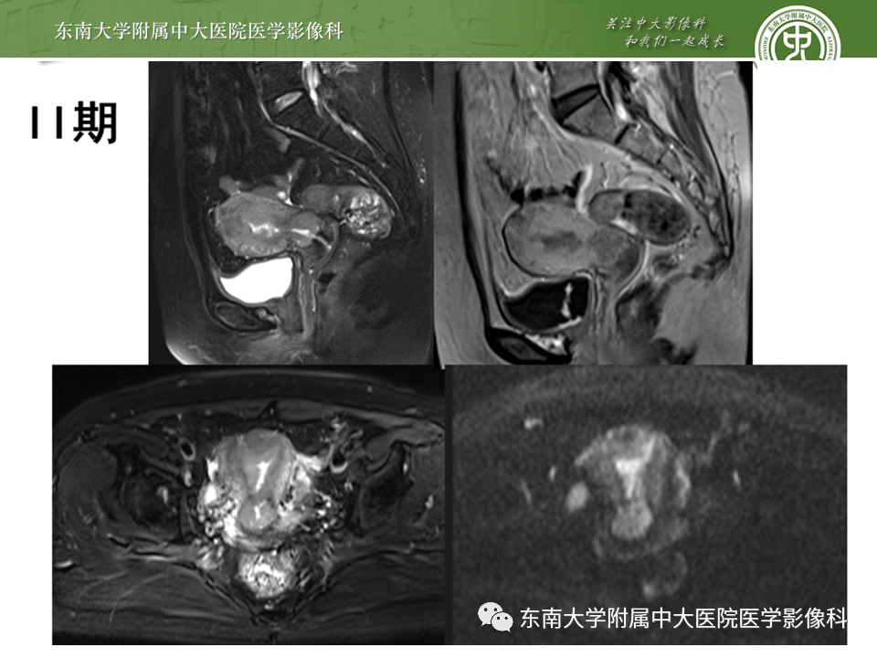 宫颈有癌变的症状怎么治疗_早期宫颈癌的哪8种症状表现_宫颈有炎症的症状表现