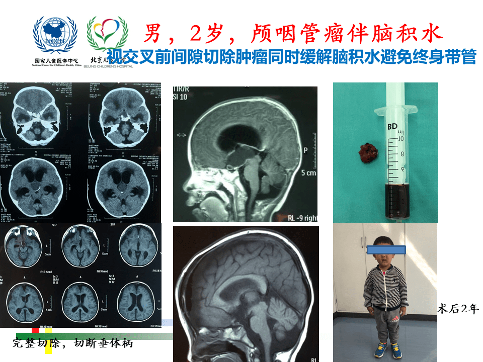 解剖课件 儿童鞍区肿瘤常见手术入路 北京儿童医院葛明