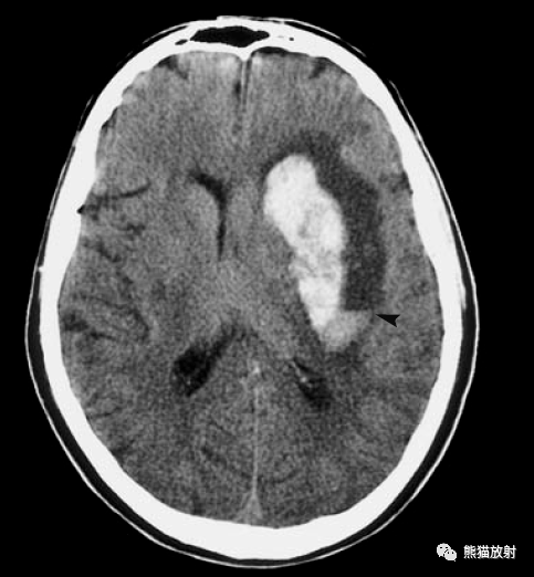脑实质内出血的演变,分布,ct表现