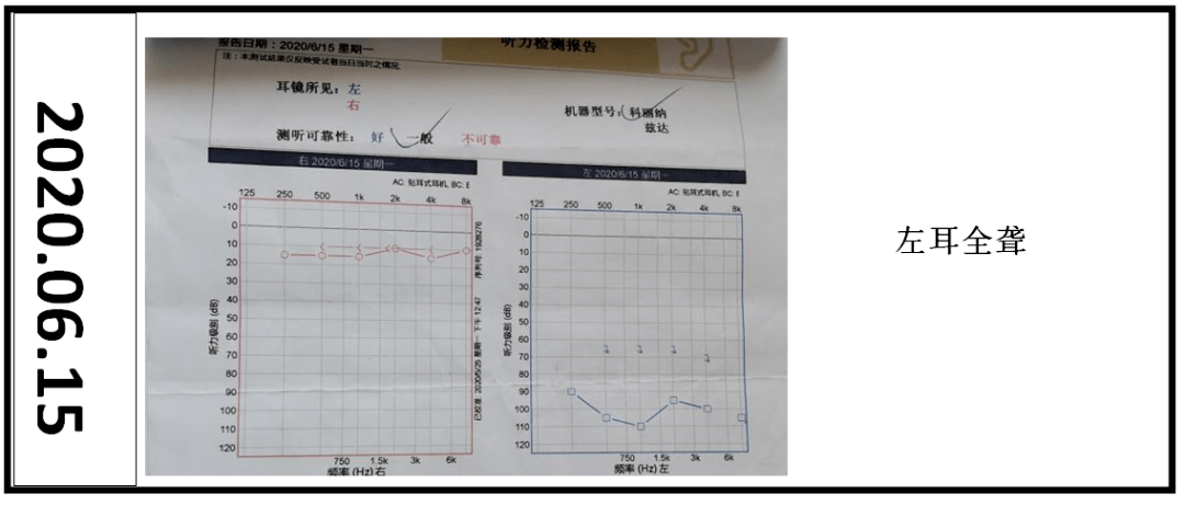 电测听标准正常图图片