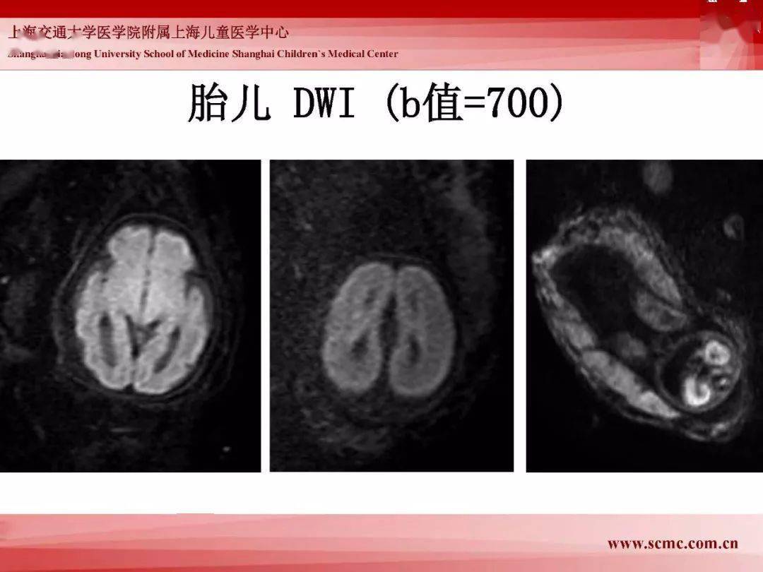 胎兒磁共振的檢查技術